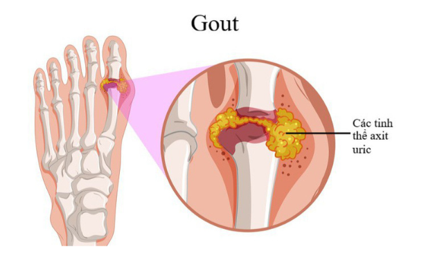 Biểu hiện của bệnh gout