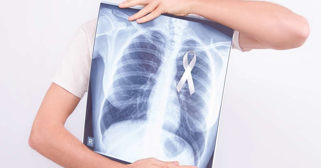Cần chụp Q quang phổi để phát hiện bệnh
