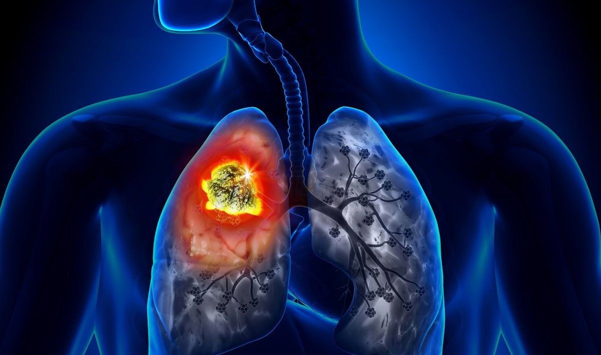 Các triệu chứng báo bệnh ung thư phổi